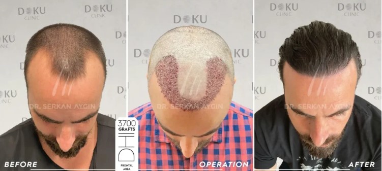 Przeszczep włosów w Turcji: jak planowanie 3D, DHI i Sapphire FUE zmieniają leczenie